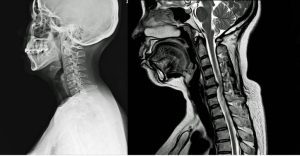 mielopatia cervical